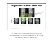 Load image into Gallery viewer, Degenerative arthritis of the knee stages