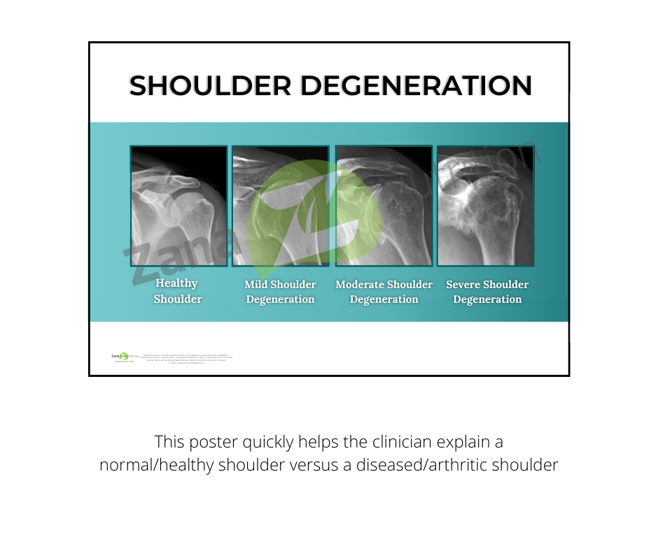 Shoulder degeneration chart