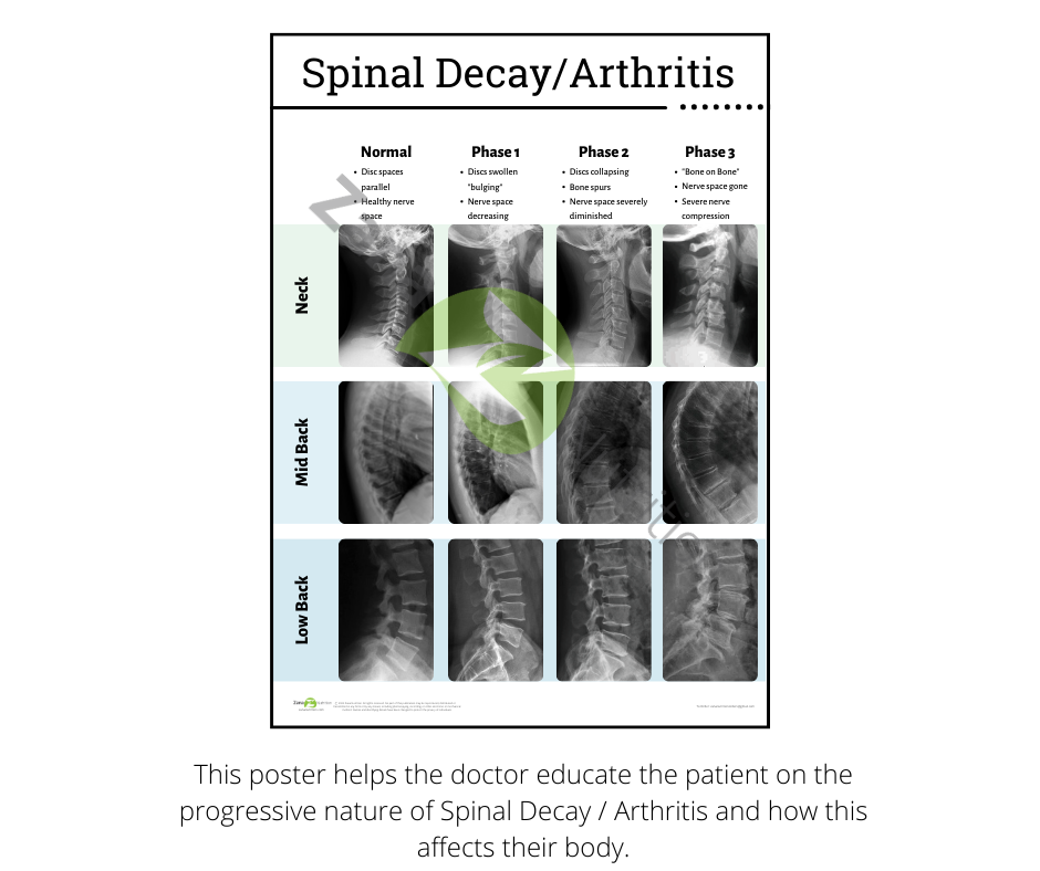 Spinal Decay phases