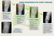 Load image into Gallery viewer, Knee degenerative joint disease stages