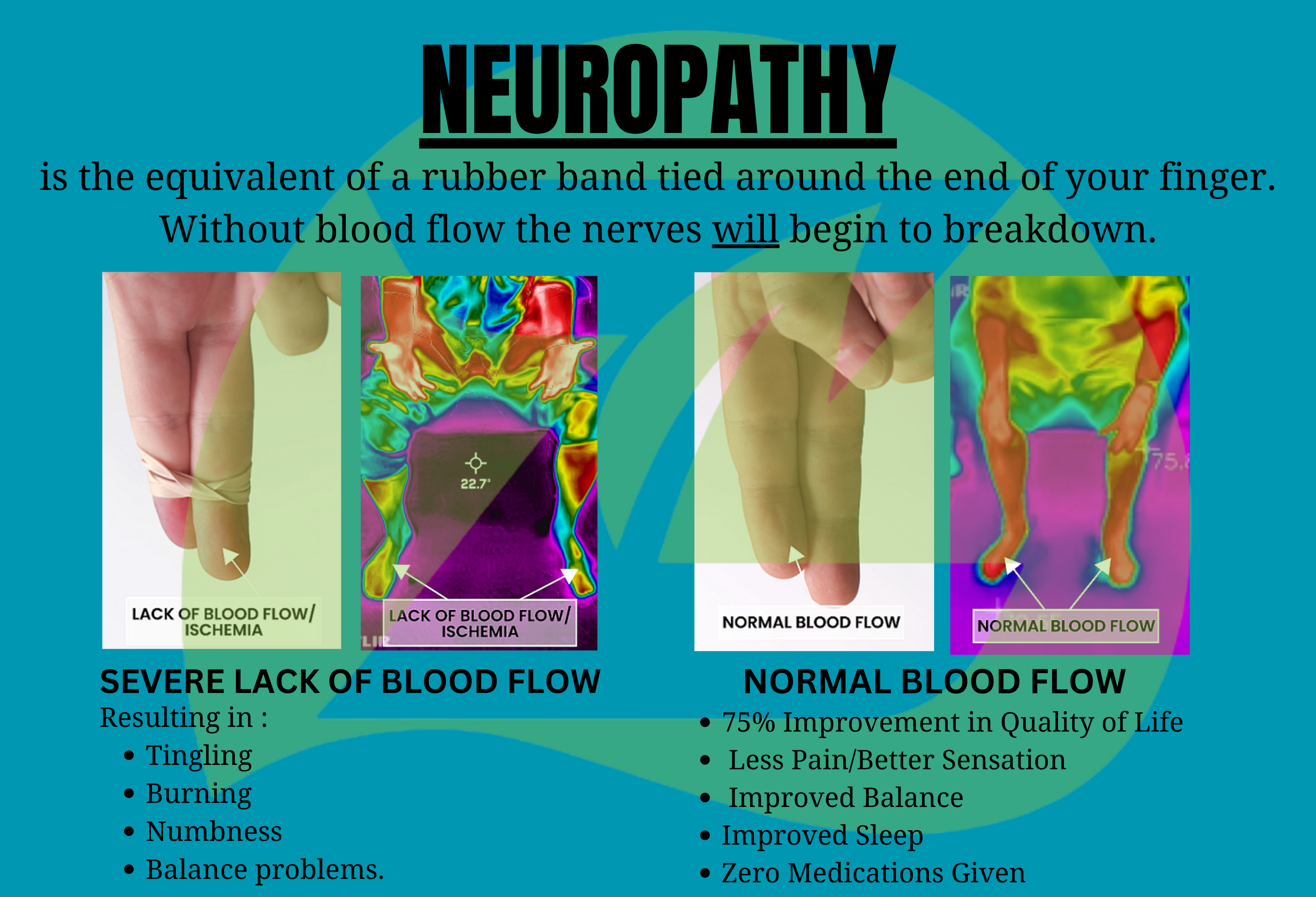 neuropathy explained