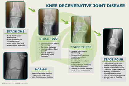 Knee degenerative joint disease stages