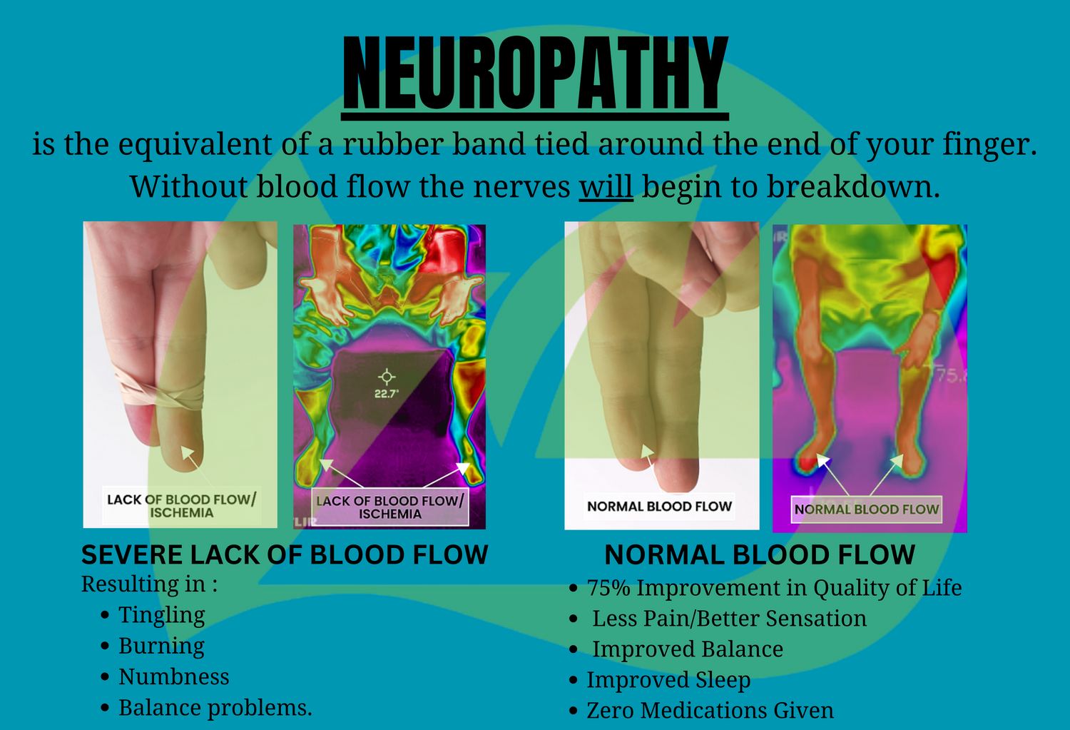 neuropathy explained