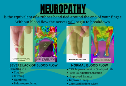 neuropathy explained